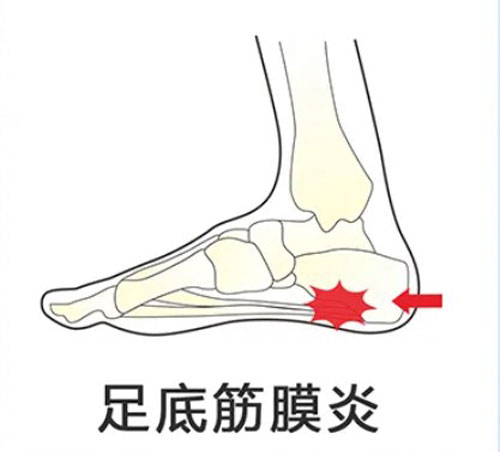 足底筋膜炎带来疼痛，穿着矫正鞋垫来舒缓